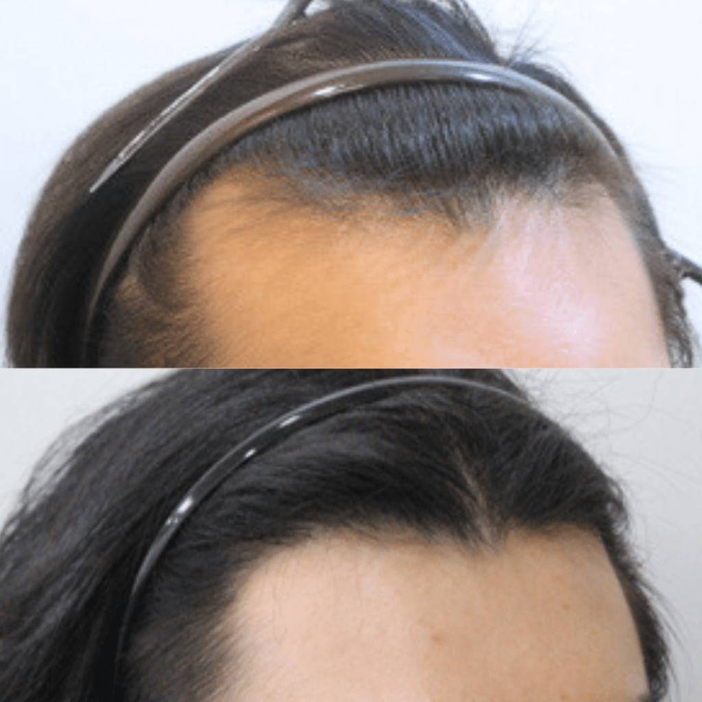 Debunking Hair Transplantation Myths in Korea