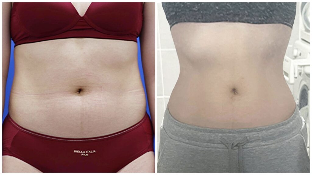 Deep Layer Abdominal Liposuction in Korea