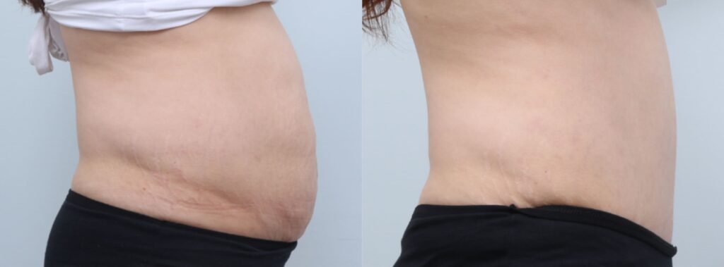 Diet After Abdominoplasty in Korea