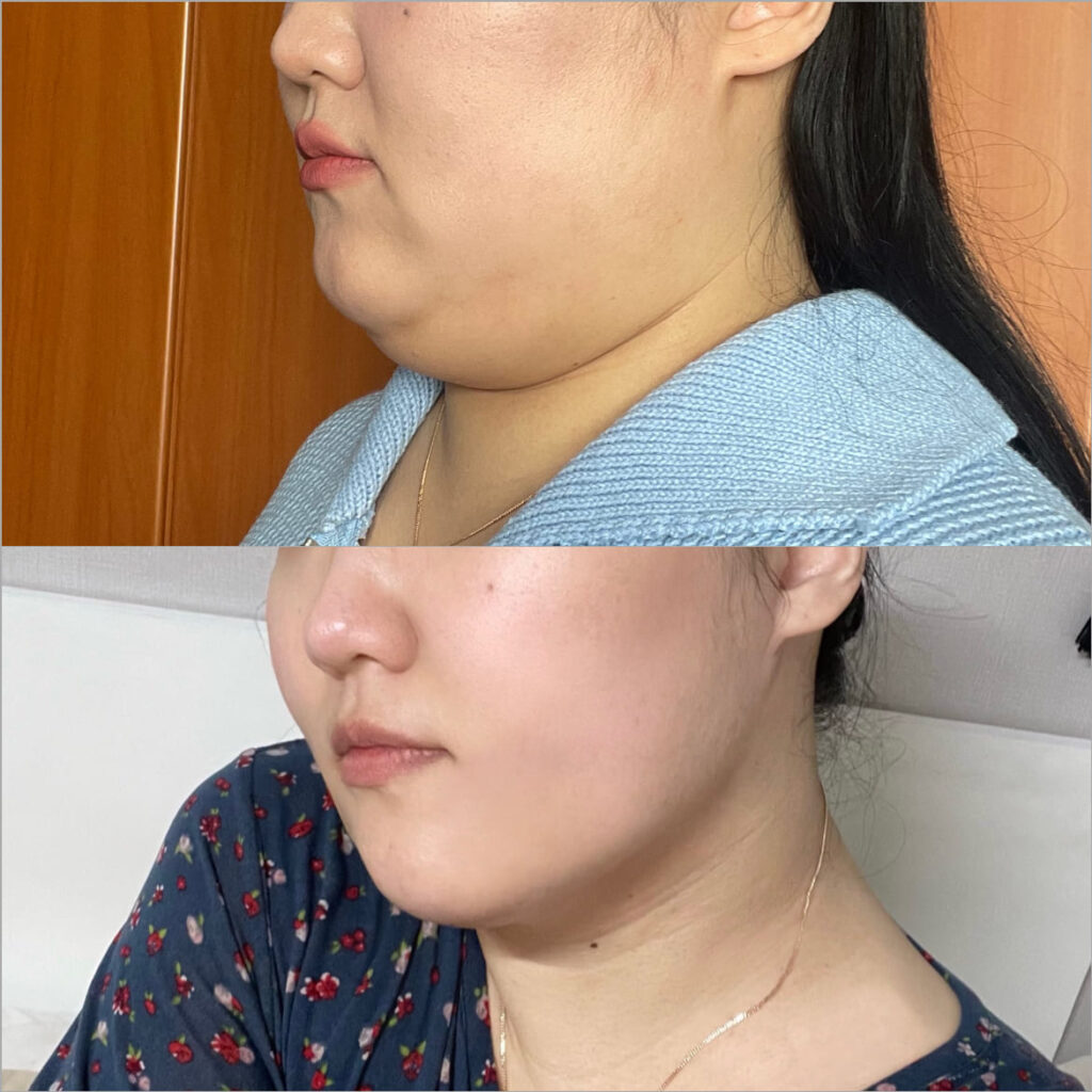 Double Chin Liposuction in Korea