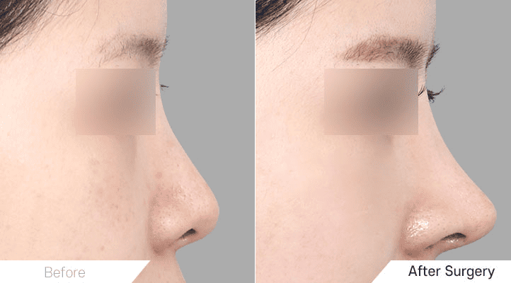 Dreaming of a Longer Nose_ Short Nose Rhinoplasty Can Help in Korea