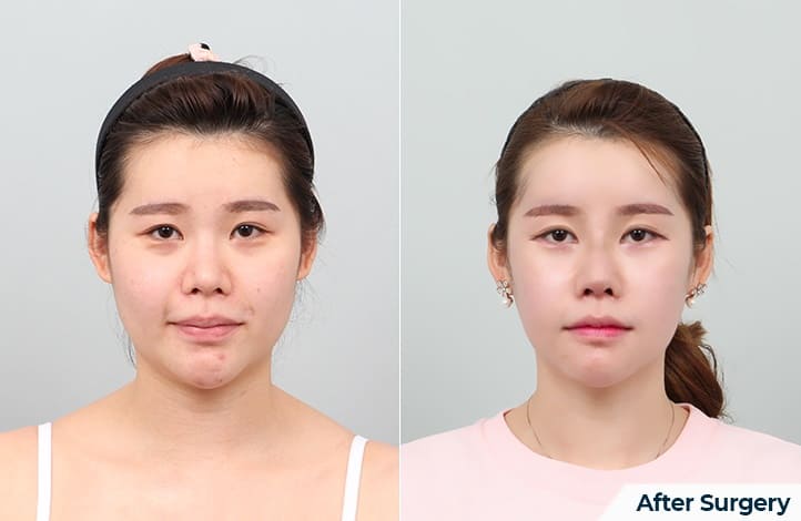 Effective Face Lifting Methods in Korea