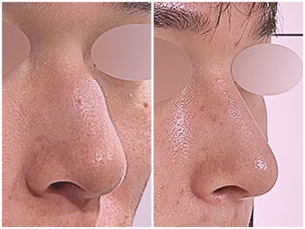 Effective Methods of Nose Correction in Korea