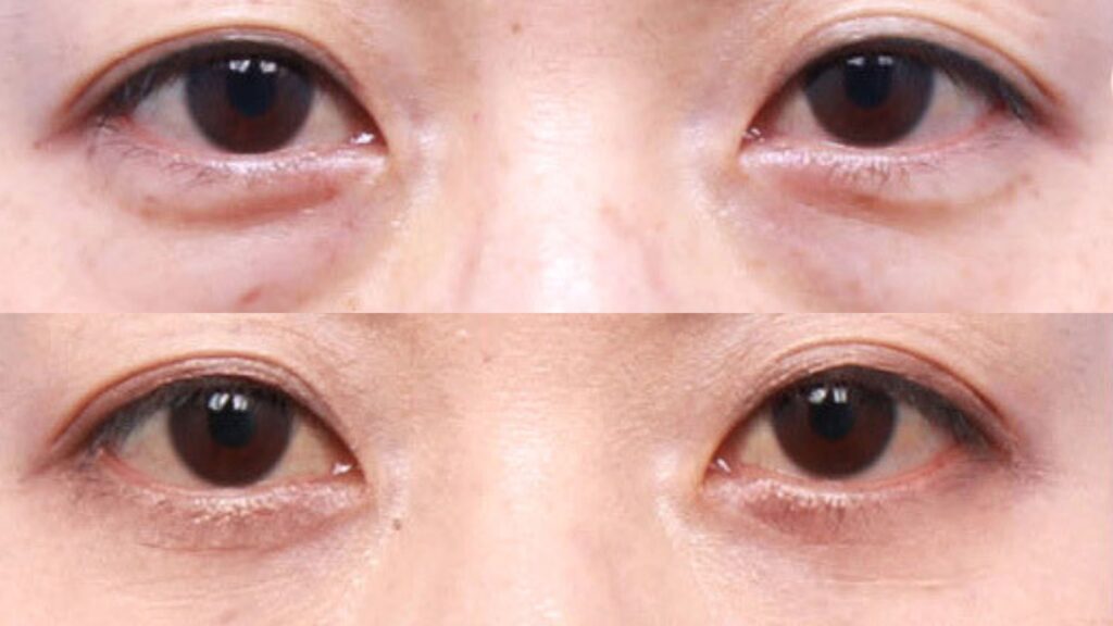 Effects of Lower Blepharoplasty in Korea