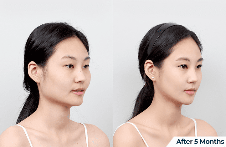 Eliminating the Square Jaw_ A Step-by-Step Process in Korea