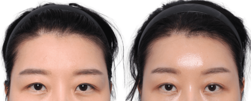 Endoscopic Forehead Lift in Korea