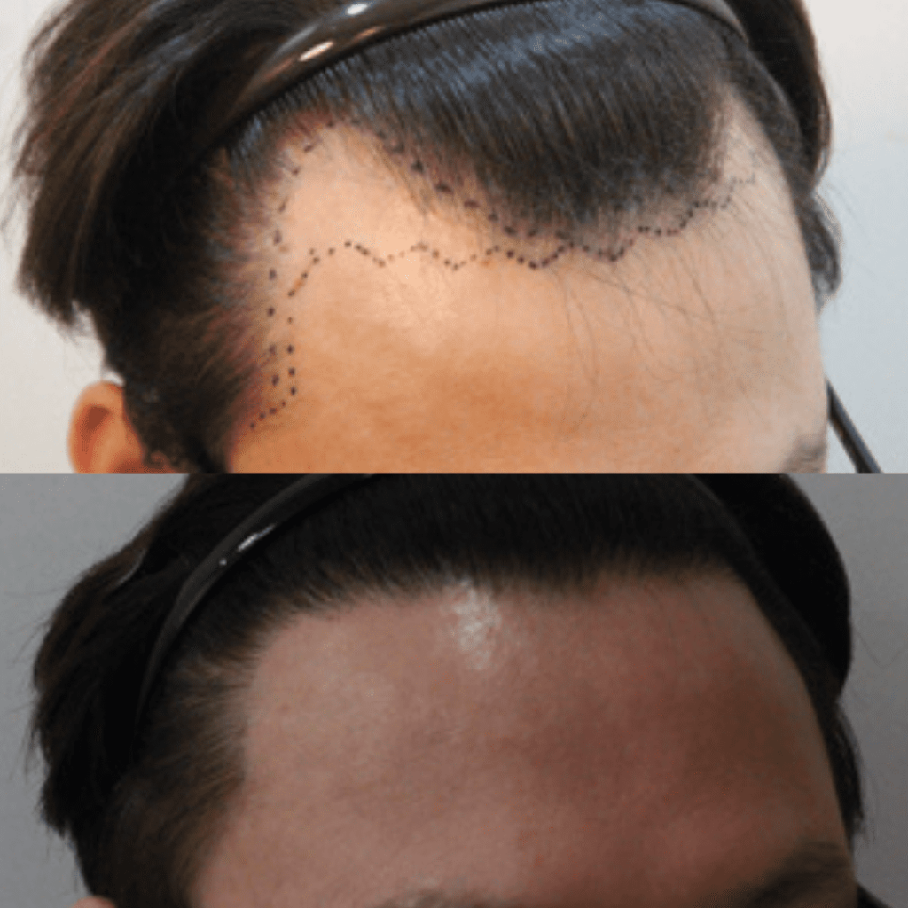 Enhancing Appearance Through Hair Transplantation in Korea