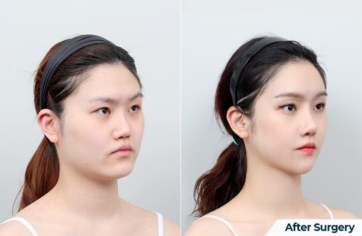 Enhancing Appearance with V-line Surgery in Korea