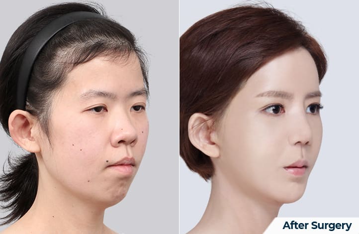 Enhancing Chin Contour in Korea