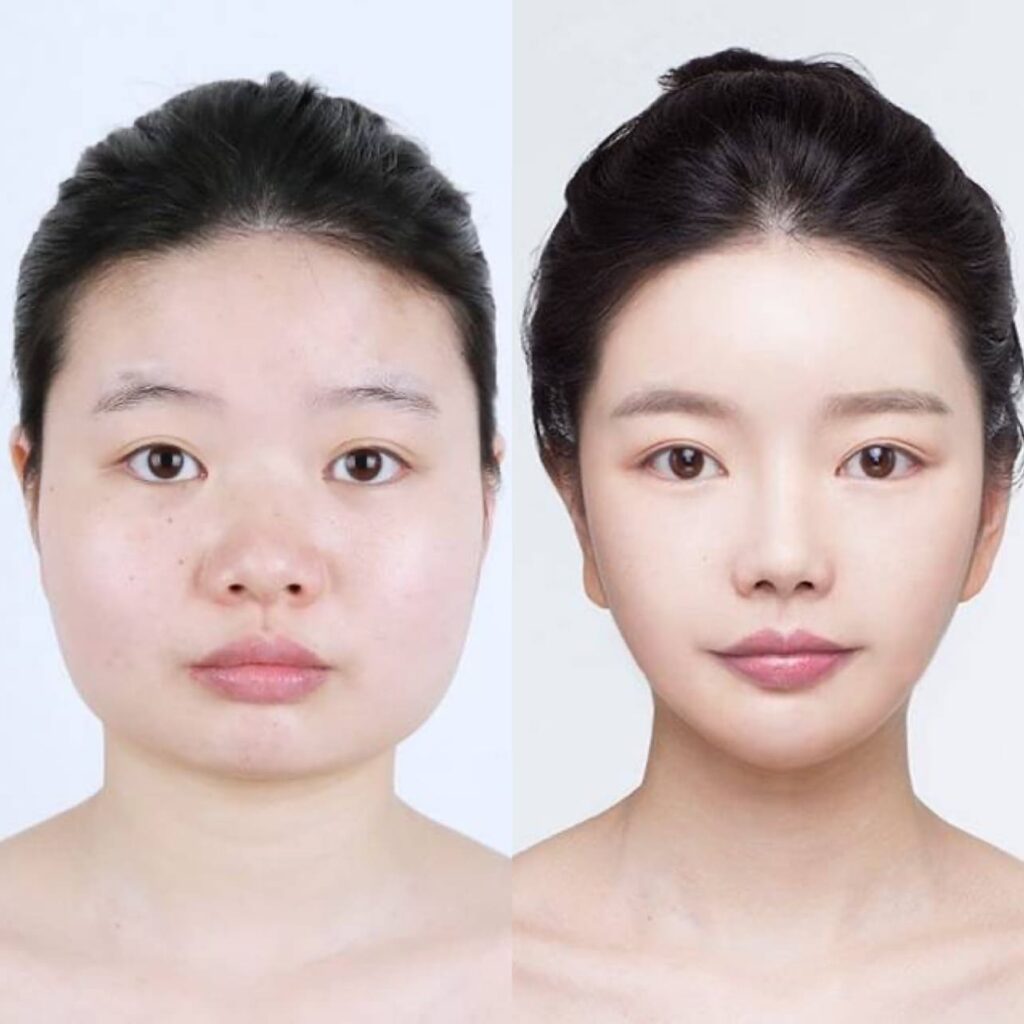 Enhancing Facial Contour with V-line Surgery in Korea