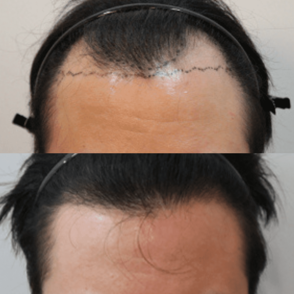 Enhancing Self-Esteem Through Hair Restoration in Korea