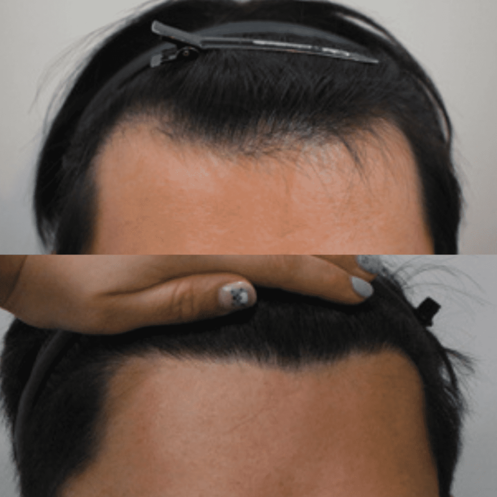 Evaluating the Cost of Hair Transplant Surgery in Korea