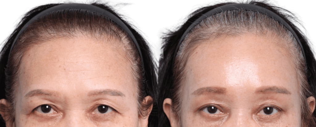 Expected Results of Forehead Lift in Korea