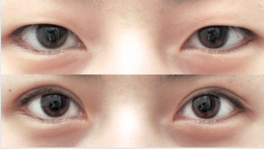 Exploring Asian Blepharoplasty Procedure in Korea