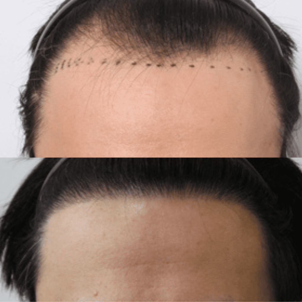 Exploring Hair Transplantation Innovations in Korea