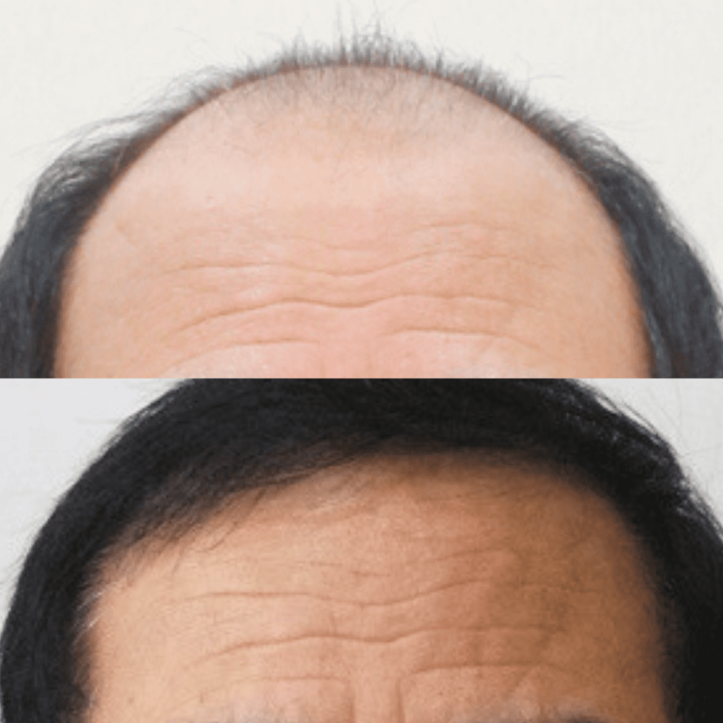 Exploring Non-Surgical Hair Transplant Options in Korea