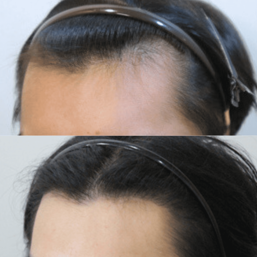 Exploring Robotic Hair Transplantation Technology in Korea