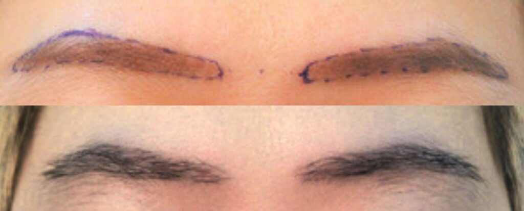 Eyebrow Transplant Stages_ Visual Guide