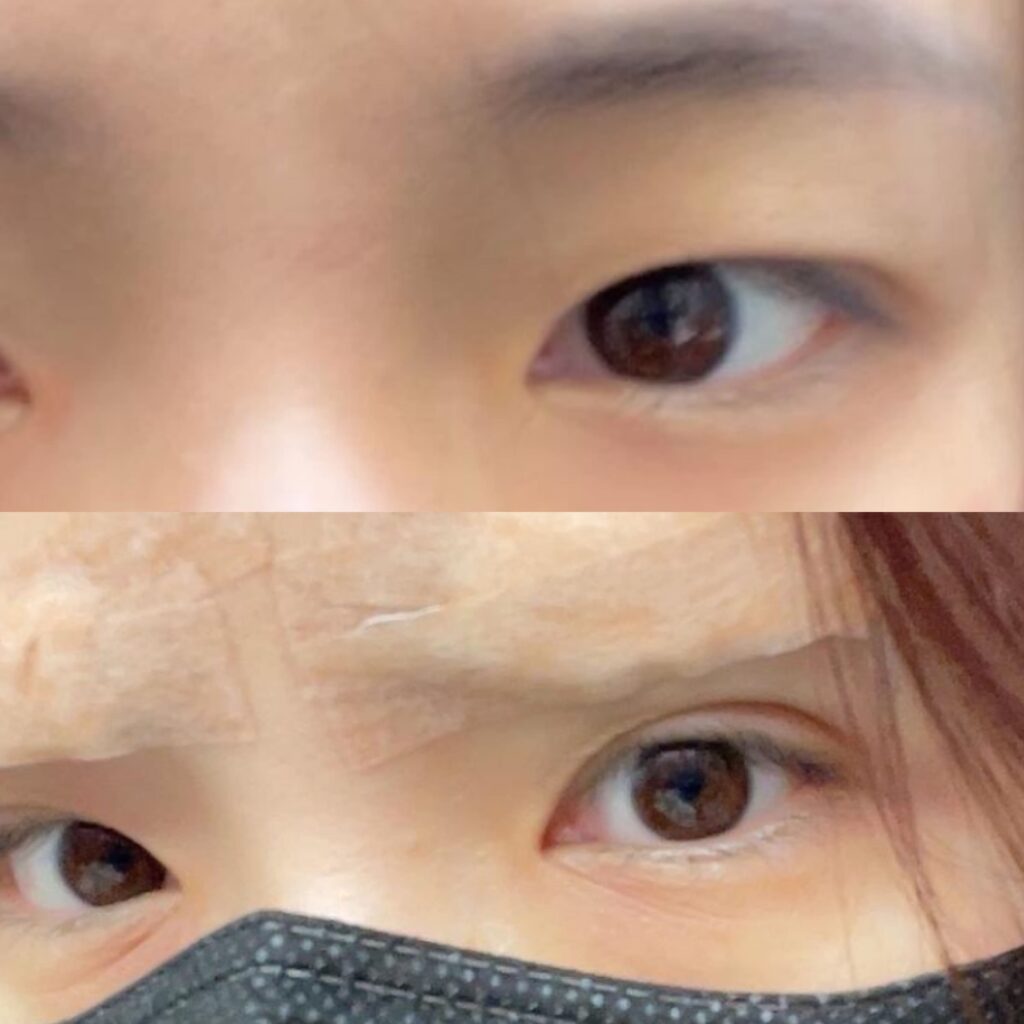 Eyelid Lift Before and After in Korea