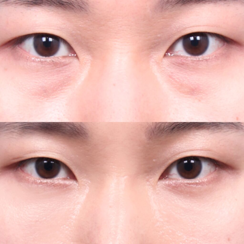 Eyelid Surgery for a Youthful and Fresh Look in Korea