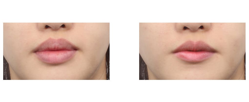 FAQ about Lip Surgery in Korea