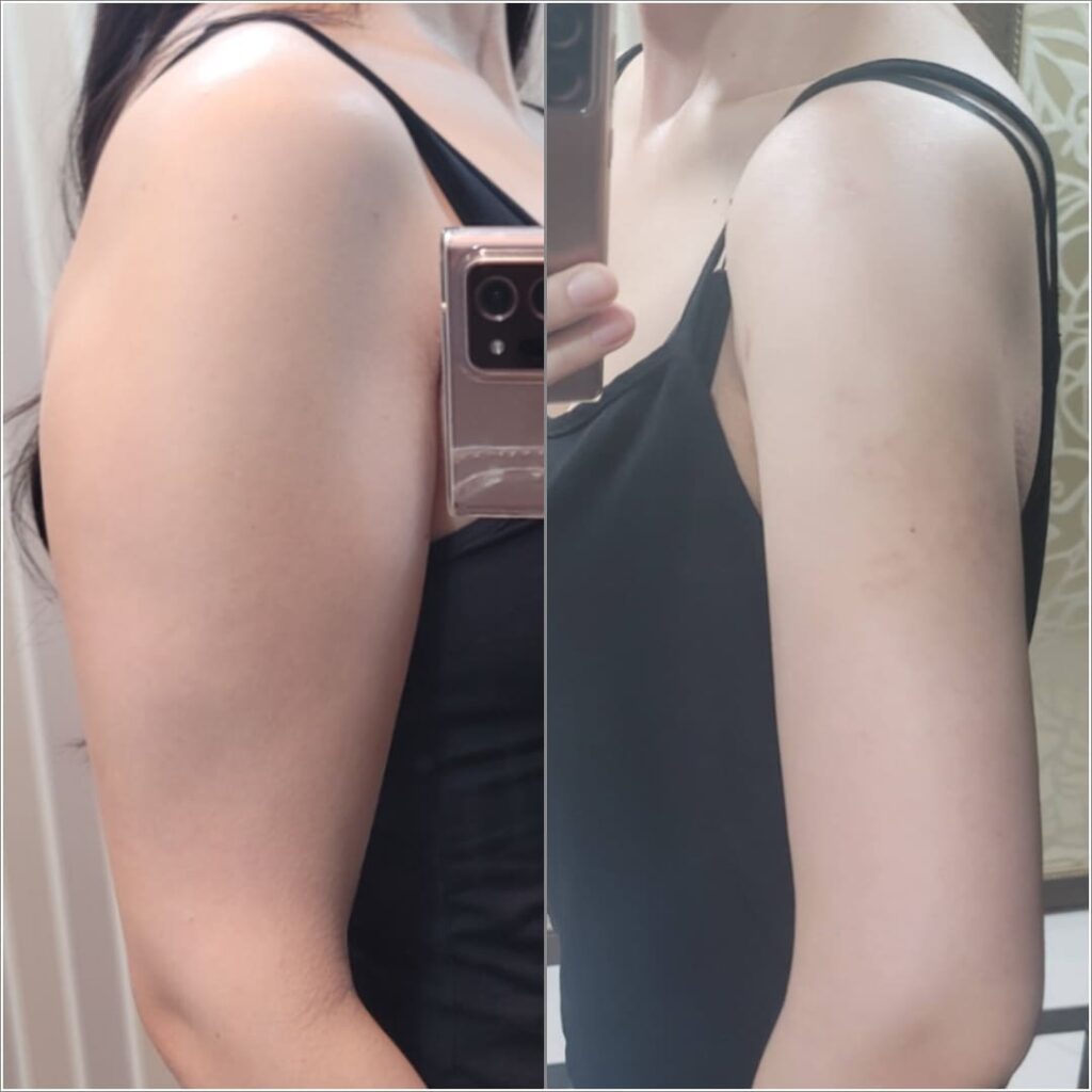 FAQs About Arm Liposuction in Korea