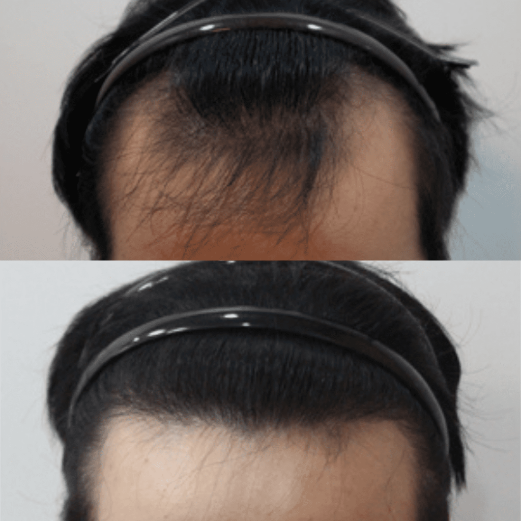 FAQs About Hair Transplantation in Korea