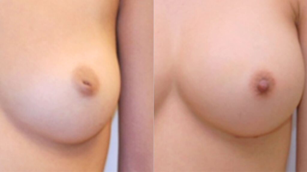 FAQs on Nipple Reduction in Korea