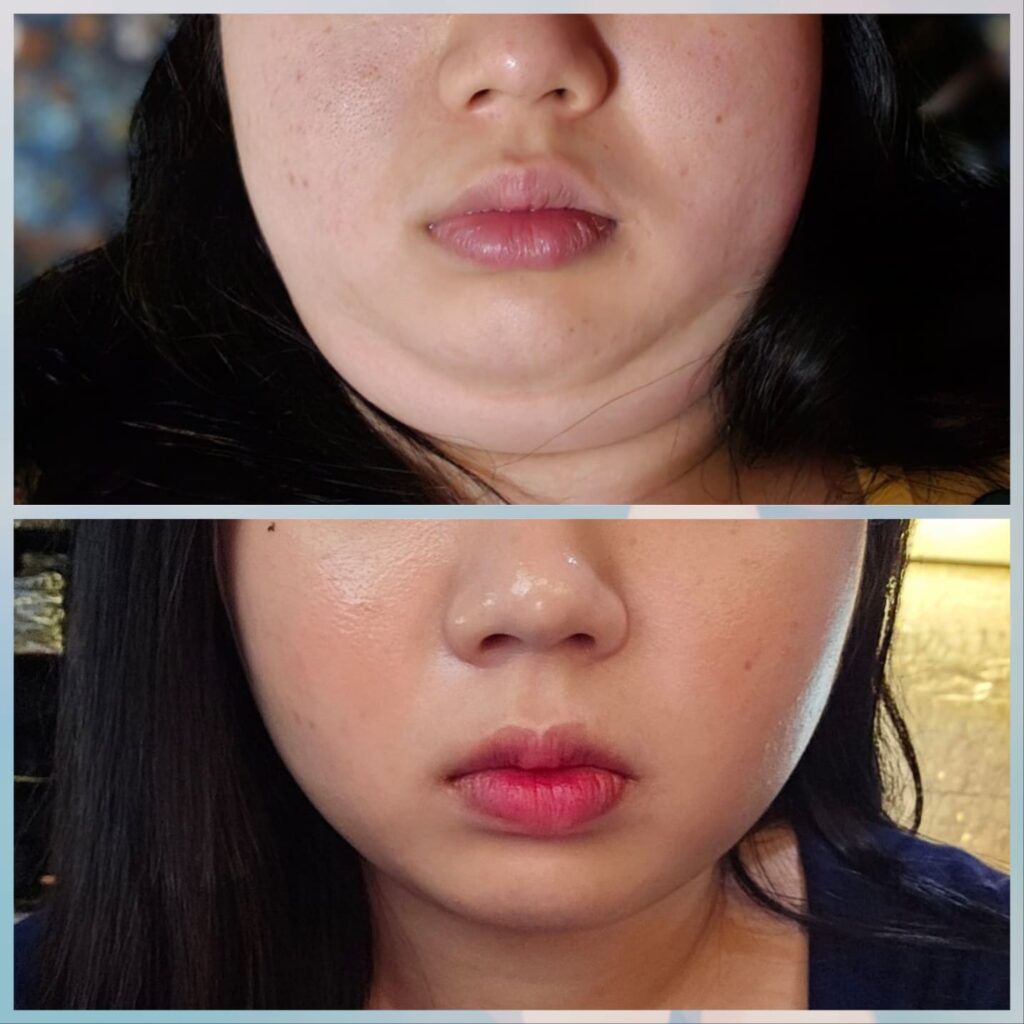 Face Liposuction Treatment Plan in Korea