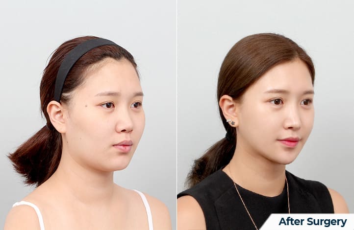 Facial Aesthetics_ Jaw Volume Reduction in Korea