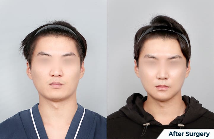 Facial Contour Surgery_ A Transformation in Korea