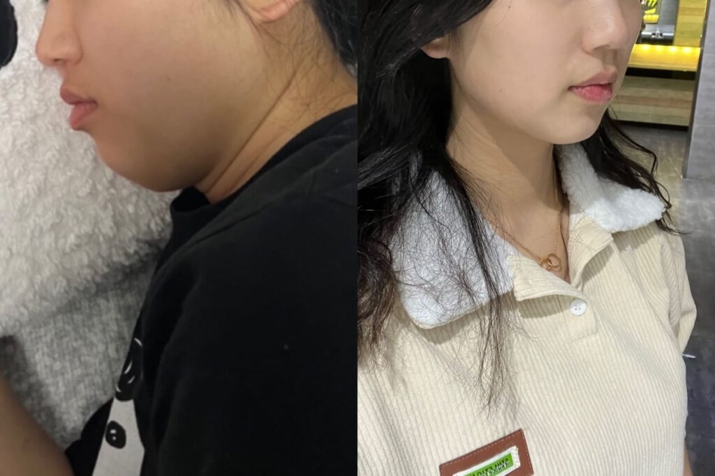 Facial Contouring with Liposuction in Korea