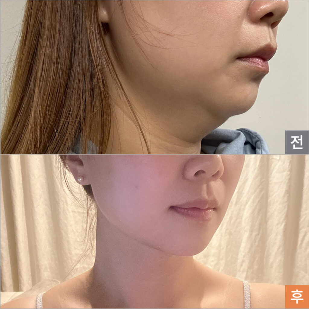 Facial Rejuvenation Through Liposuction in Korea