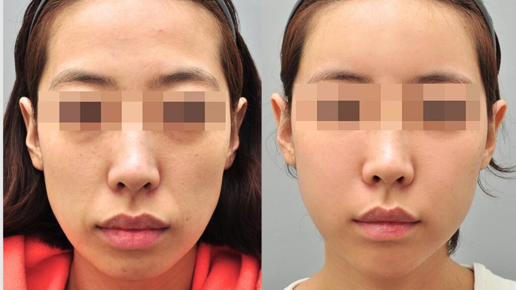 Facial Rejuvenation with Lipofilling