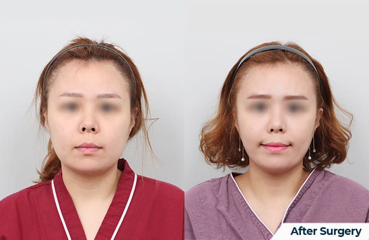 Facial Transformations through Korean Lifting Methods