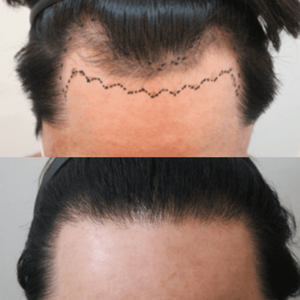 Factors to Consider Before Hair Transplant Surgery in Korea