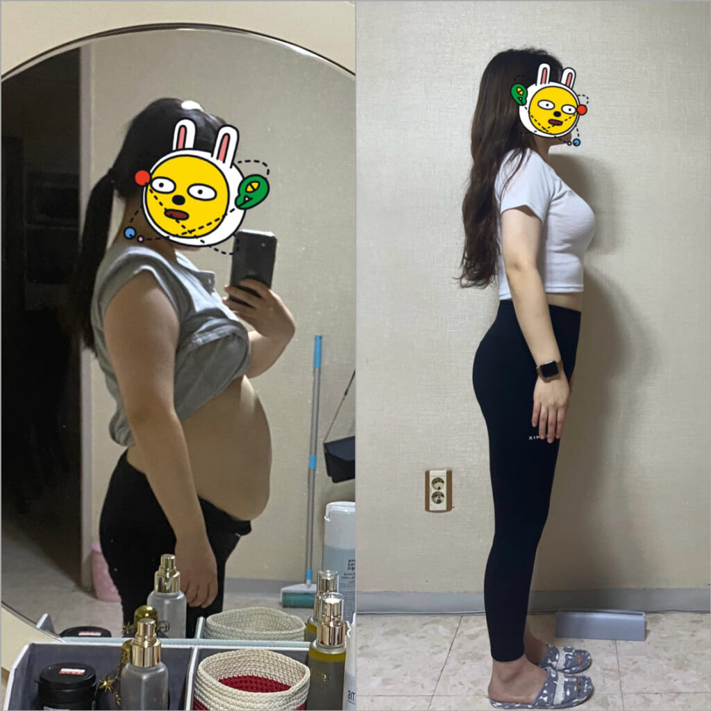 Female Abdominal Liposuction in Korea