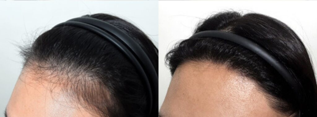 Female alopecia and solutions in Korea