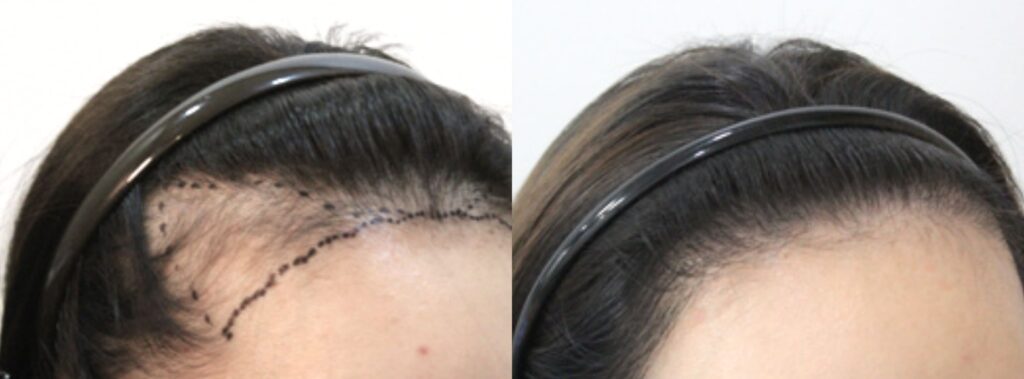 Female beauty and hair restoration in Korea