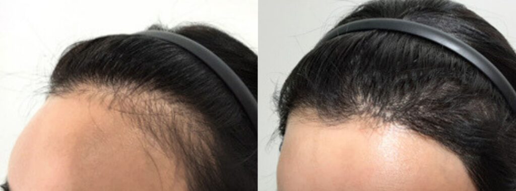 Female hair before and after transplant in Korea