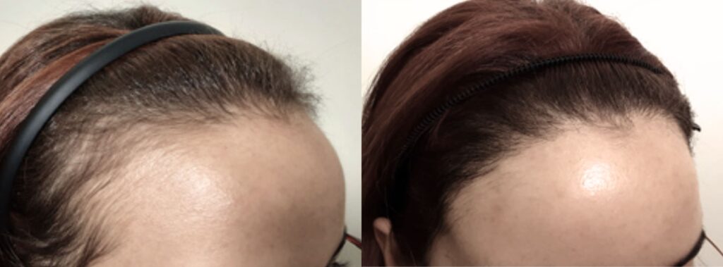 Female hair transplant process in Korea