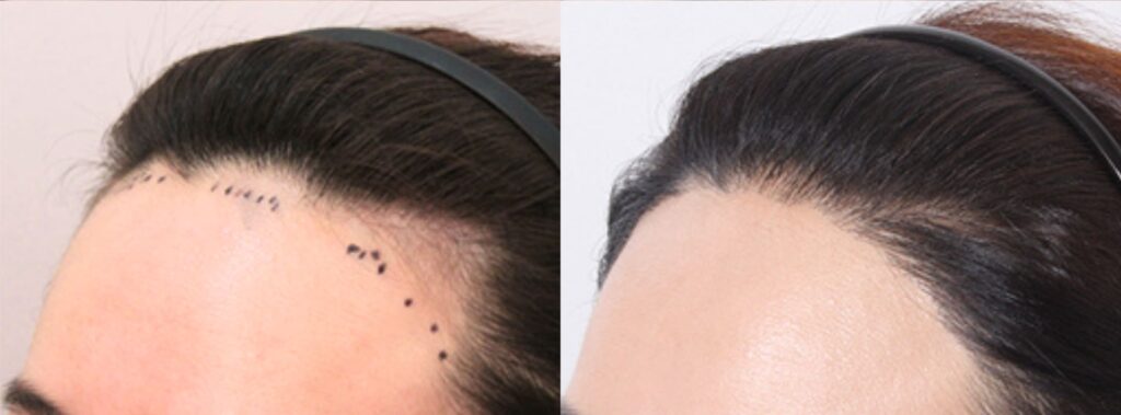 Female hair transplant_ return to youth in Korea