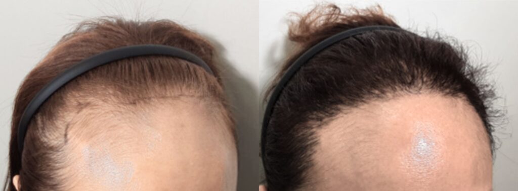 Female hair transplant_ step to happiness in Korea