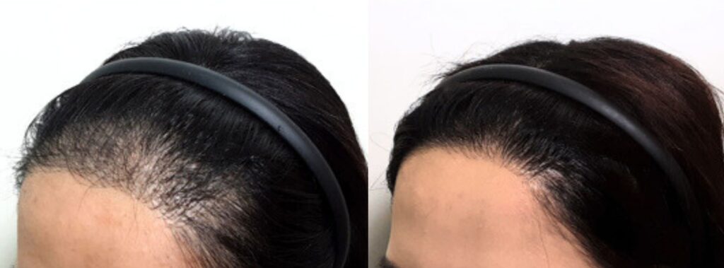 Female haircut after hair transplant in Korea