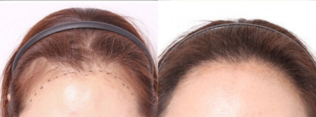 Female haircut after hair transplant_ style and care in Korea