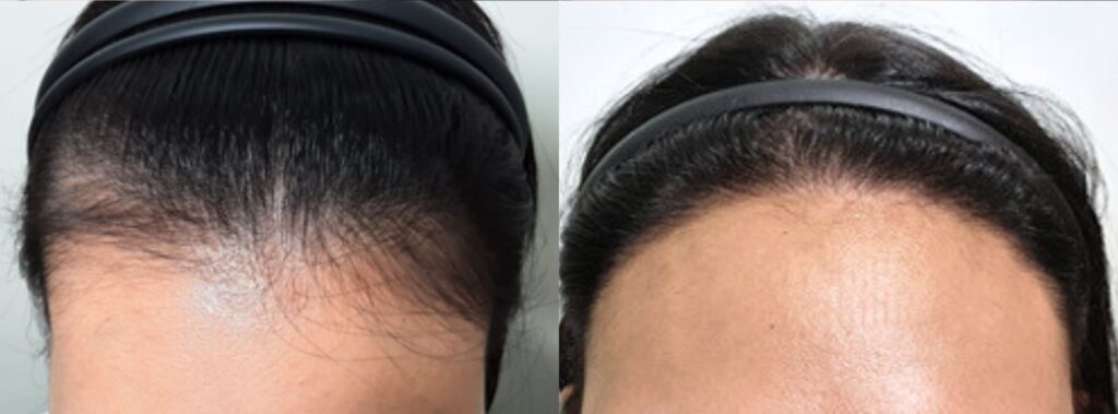 Female image after hair transplant in Korea