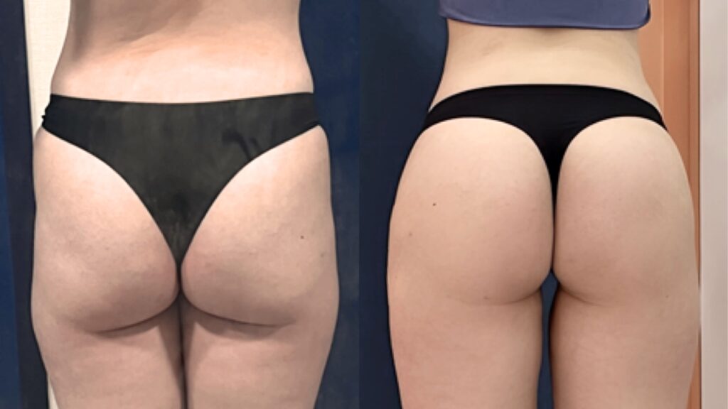 First Consultation for Buttock Lipofilling in Korea