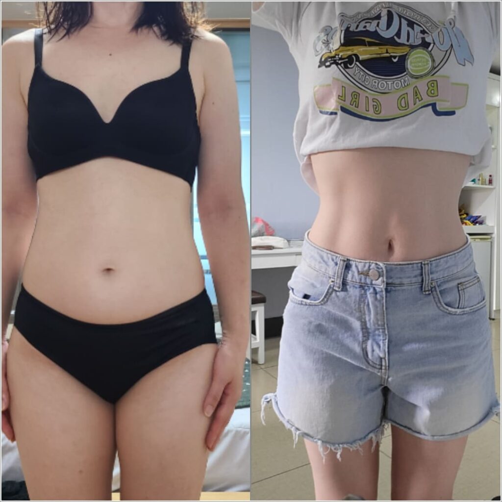 Flat Stomach Liposuction in Korea