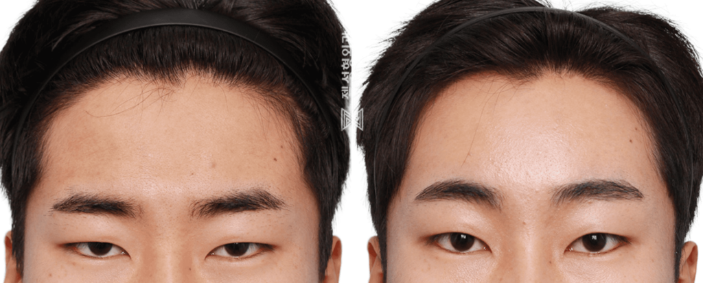 Forehead Lift Before and After in Korea