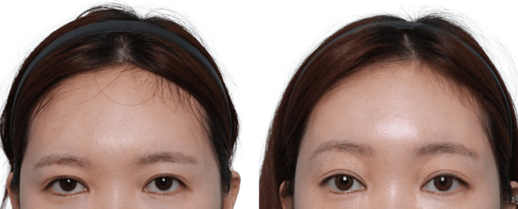 Forehead Lift Photos_ Before and After One Year in Korea